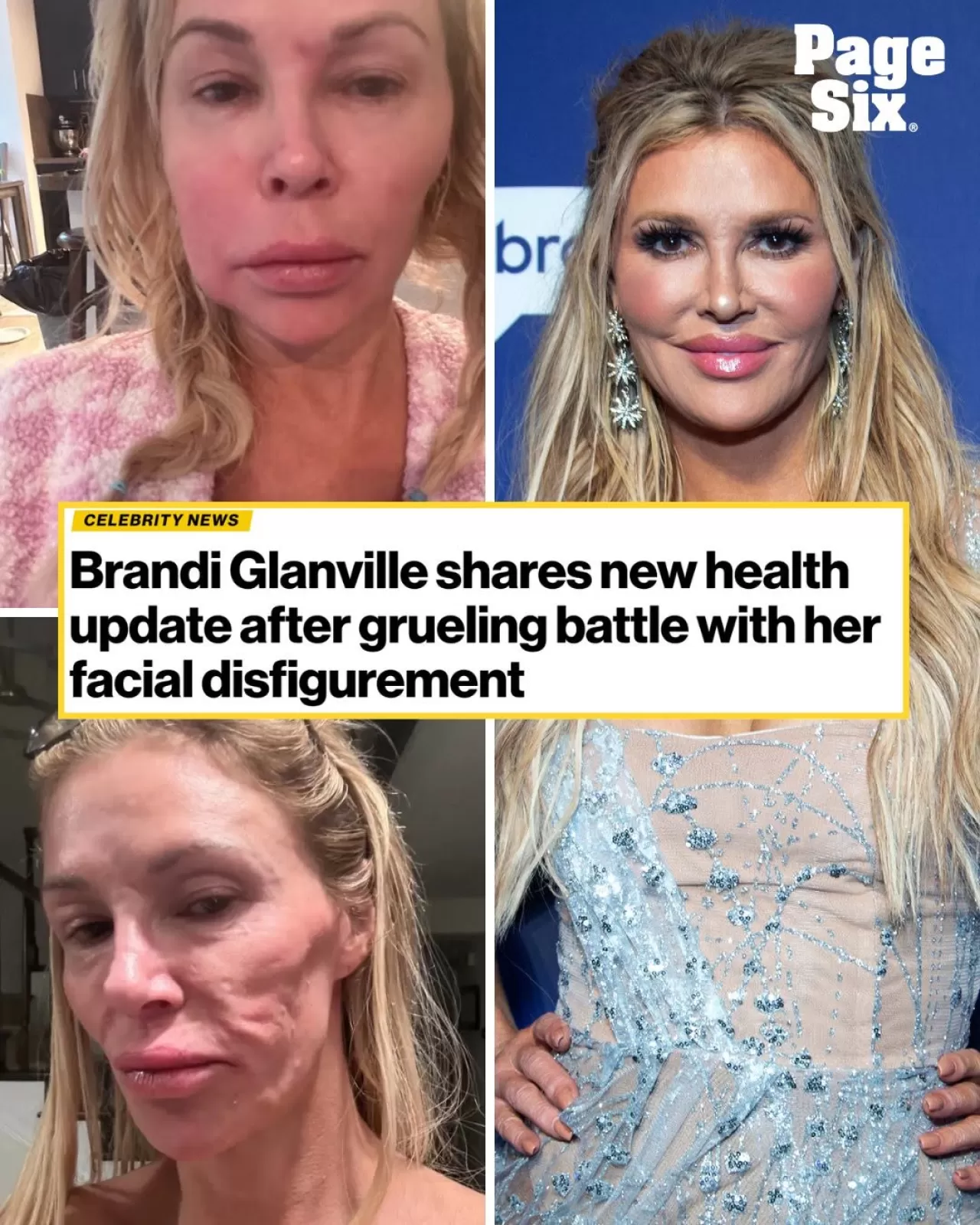 Brandi Glanville Sağlık Durumunda İyileşme Bildirdi