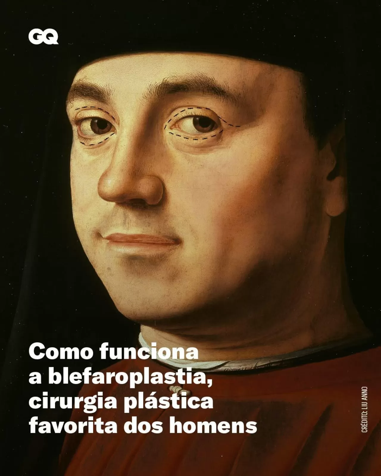 Erkeklerde Göz Kapağı Estetiği İlgi Görüyor